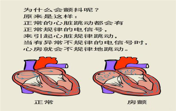 您了解心房颤动吗？